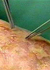 سوختگی های ناشی از آتش و یا آب جوش بسیار خطرناک است و می تواند تاثیرات قابل ملاحظه ای را بر پوست و بافت های بدن بر جای بگذارد.